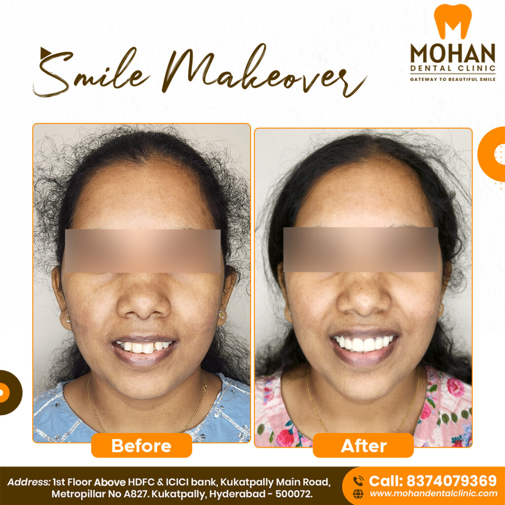 Smile Designing Cost in Hyderabad @ Mohan Dental Clinic