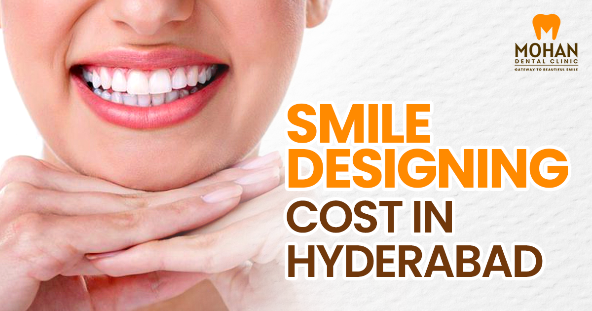 cost of smile designing in hyderabad