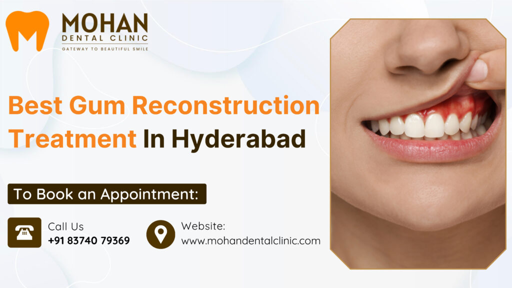 Best Gum Reconstruction Treatment In Hyderabad - Mohan Dental