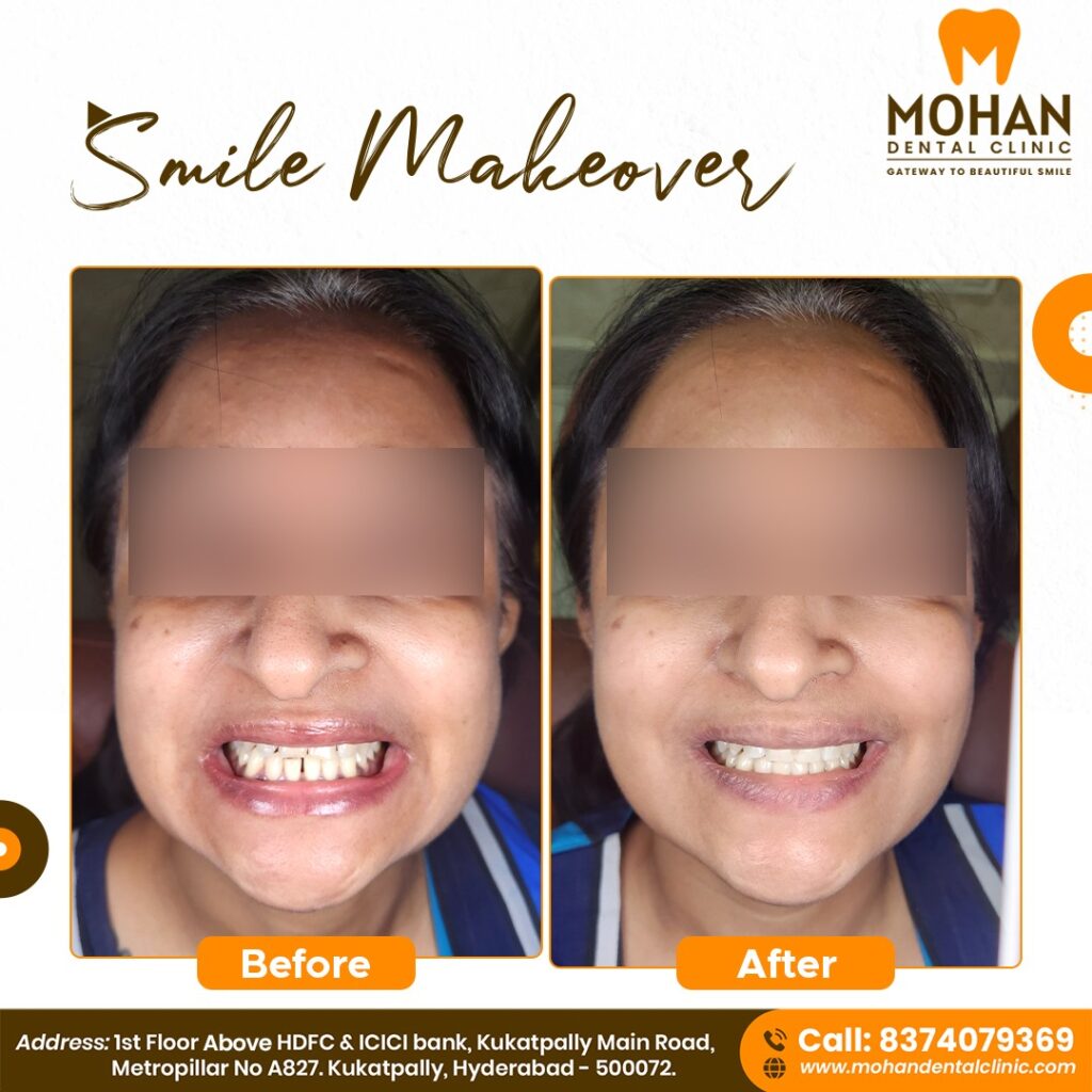 Smile Designing Cost in Hyderabad @ Mohan Dental Clinic