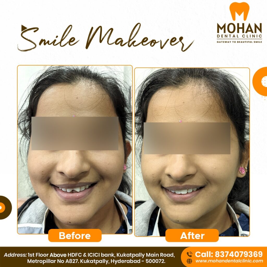 Smile Designing Cost in Hyderabad @ Mohan Dental Clinic