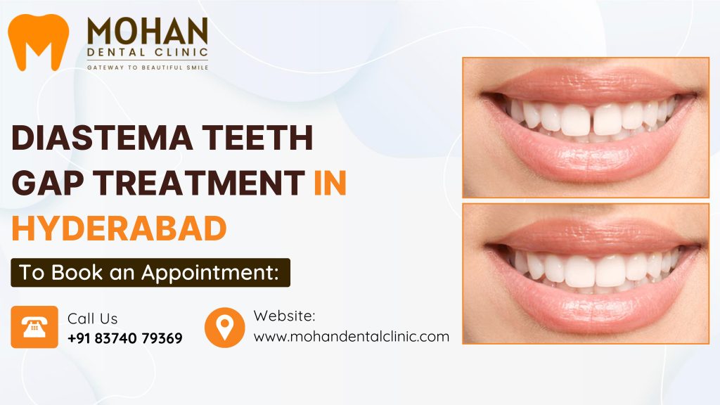Diastema Teeth Gap Treatment in Hyderabad - Mohan Dental