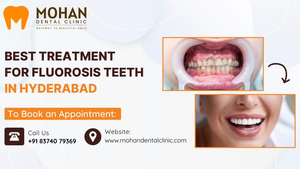 dental fluorosis treatment in Hyderabad