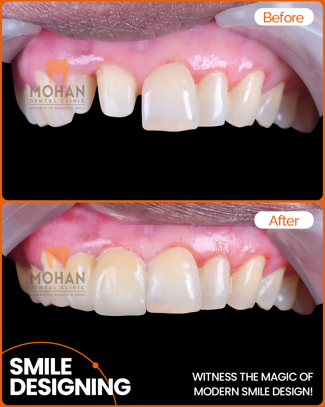 Smile-Designing-in-Hyderabad