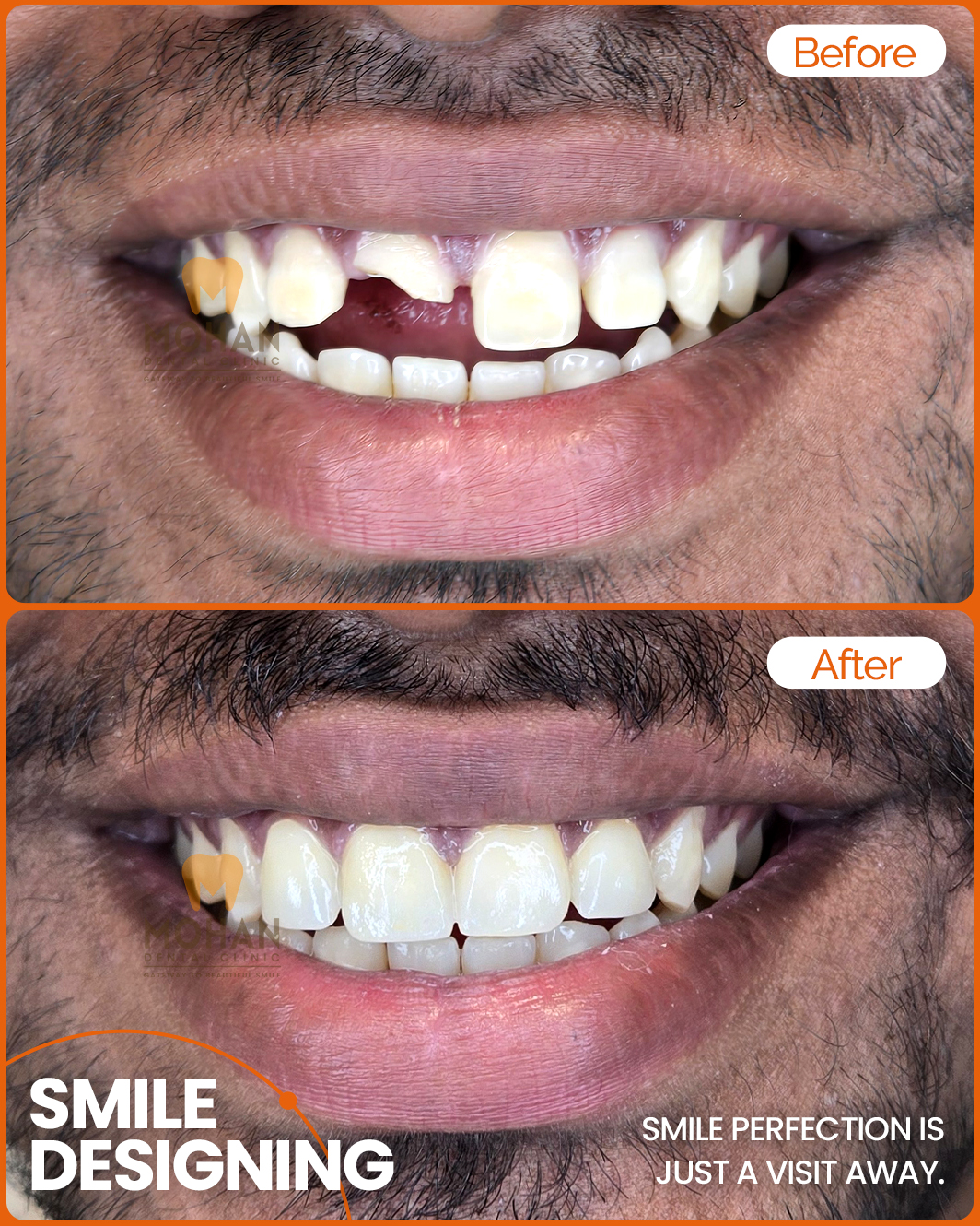 Smile-Designing-in-Hyderabad