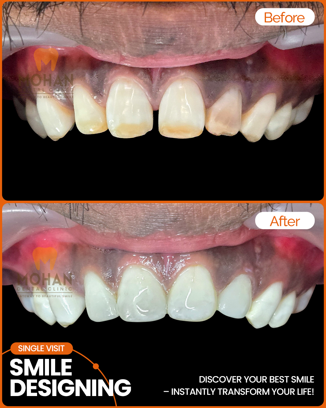 Best-Smile-Designing-Clinic-in-Hyderabad