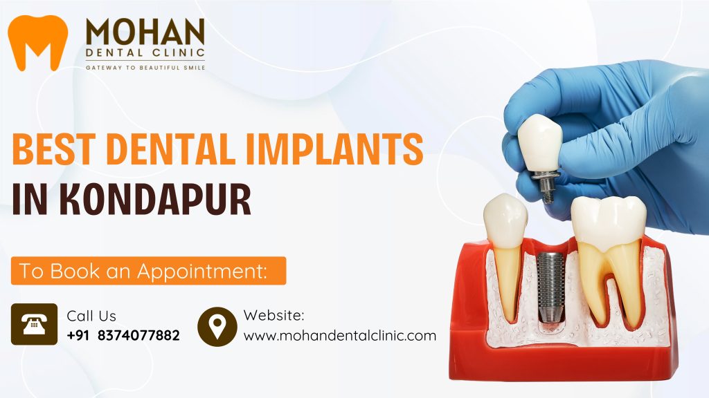 Best Dental Implants in Kondapur