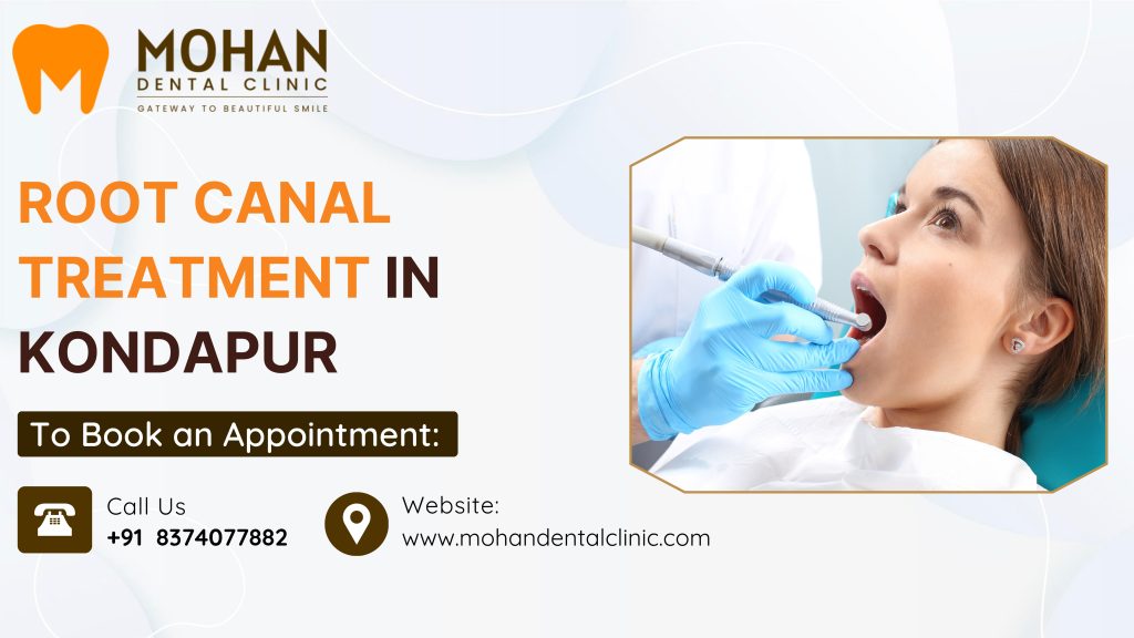 Root Canal Treatment in Kondapur
