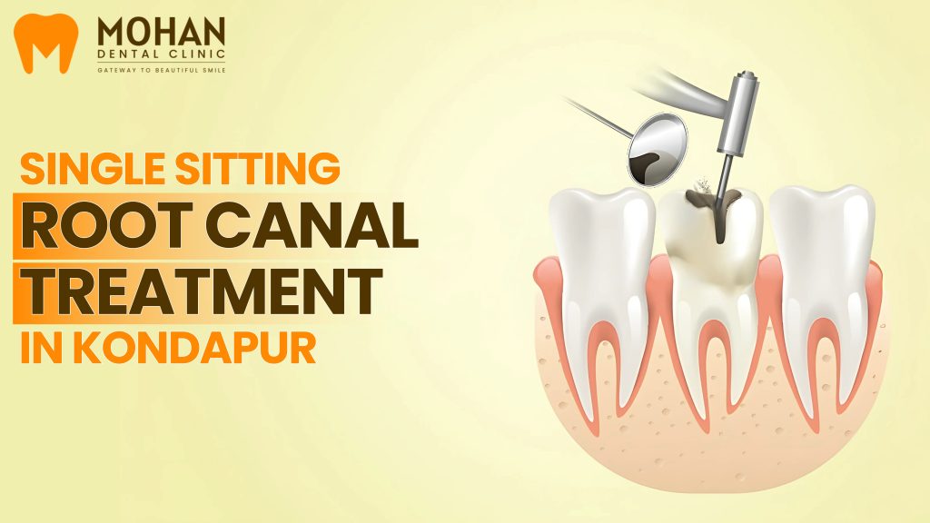 Single Sitting Root Canal Treatment in Kondapur