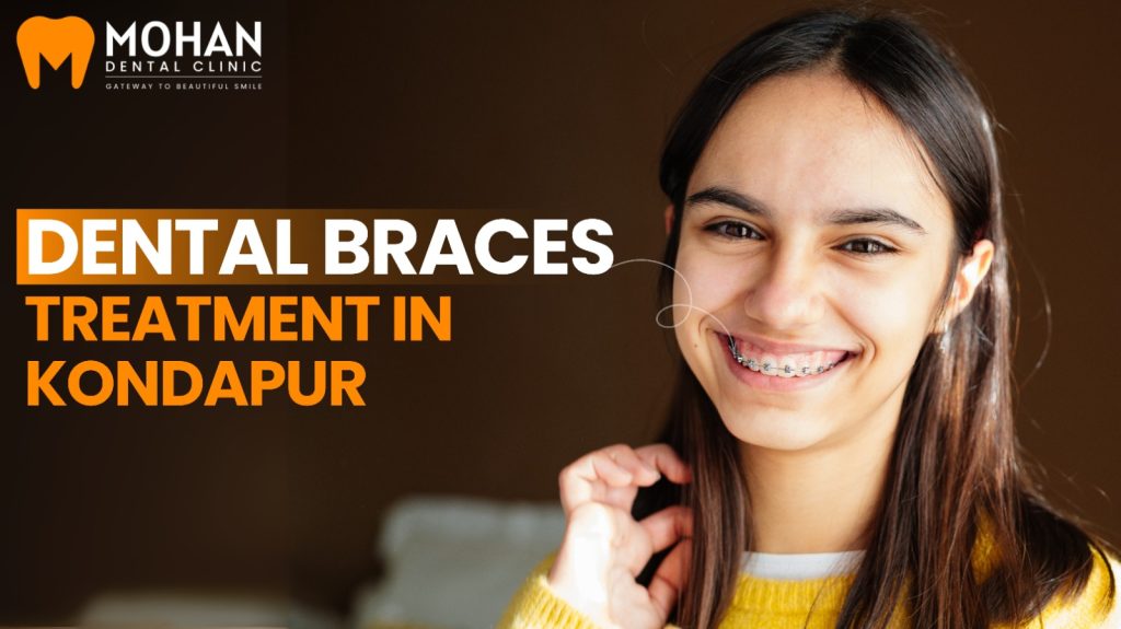 Dental Braces Treatment in Kondapur