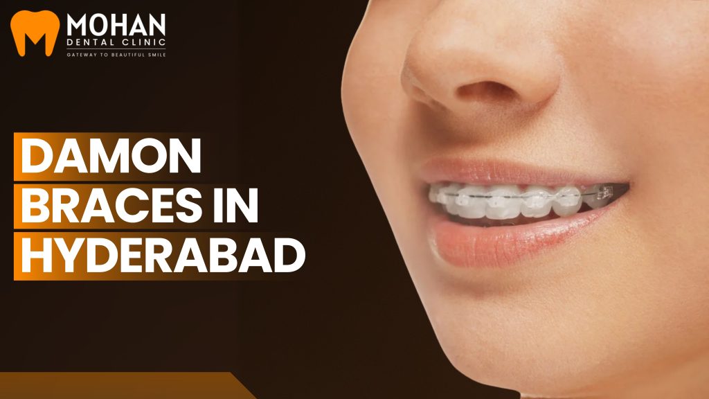 Damon Braces in Hyderabad